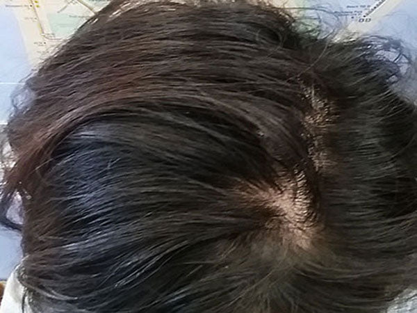 FIGHT HAIR LOSS