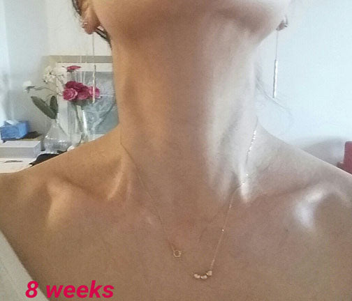 HOW TO PREVENT NECK WRINKLES